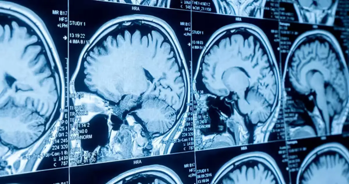 Anavex Pushes for Alzheimer’s Drug Re-Evaluation After Revised Trial Data