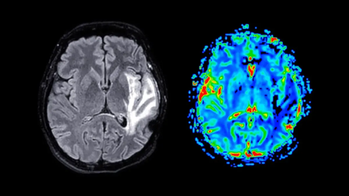 Brain scan showing vascular damage linked to obesity and dementia